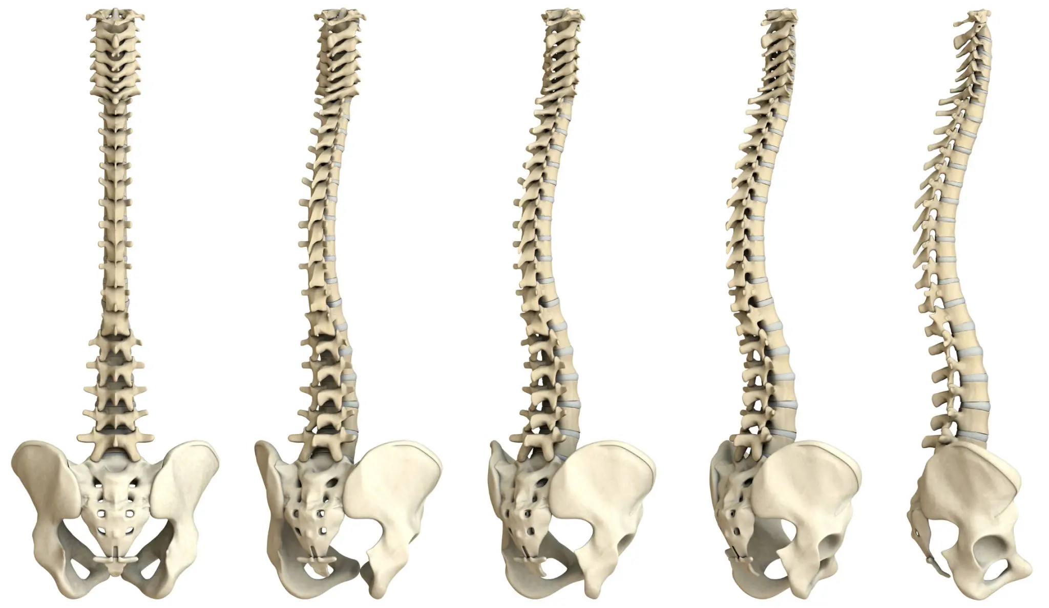 Three human spine models with pelvis bones shown from the front.